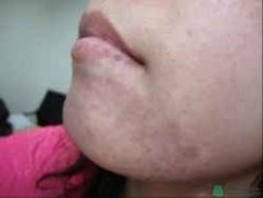 毛囊型白癜风